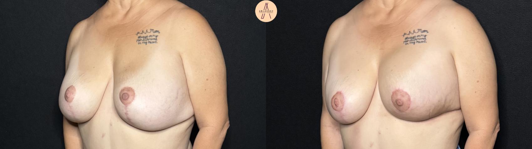 Before & After Implant Removal and Replacement  Case 278 Left Oblique View in San Antonio, Texas
