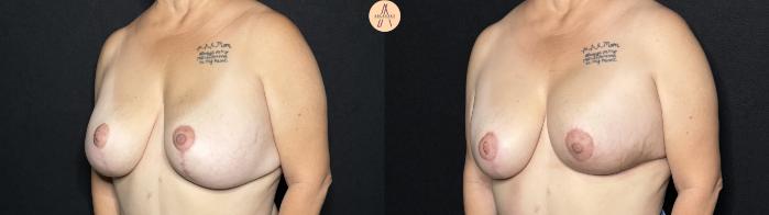 Before & After Implant Removal and Replacement  Case 278 Left Oblique View in San Antonio, Texas