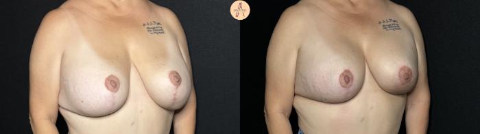 Before & After Implant Removal and Replacement  Case 278 Right Oblique View in San Antonio, Texas