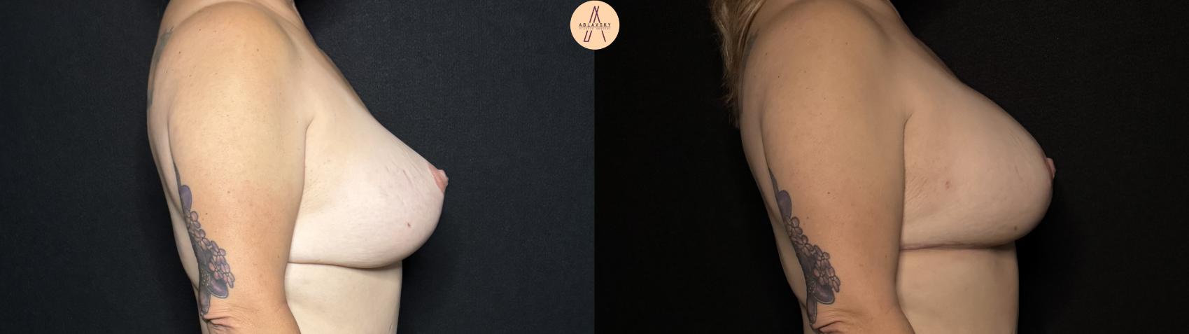 Before & After Implant Removal and Replacement  Case 278 Right Side View in San Antonio, Texas