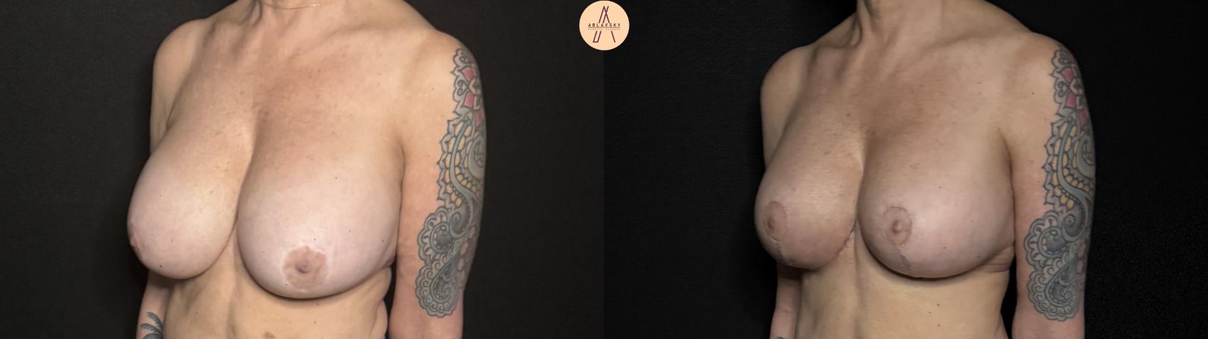 Before & After Implant Removal and Replacement  Case 335 Left Oblique View in San Antonio, Texas