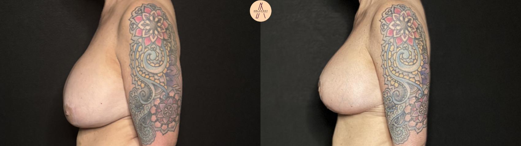 Before & After Implant Removal and Replacement  Case 335 Left Side View in San Antonio, Texas