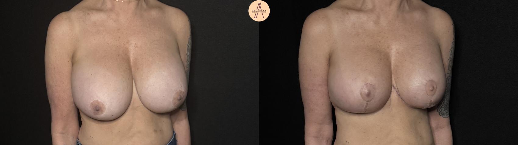 Before & After Implant Removal and Replacement  Case 335 Right Oblique View in San Antonio, Texas