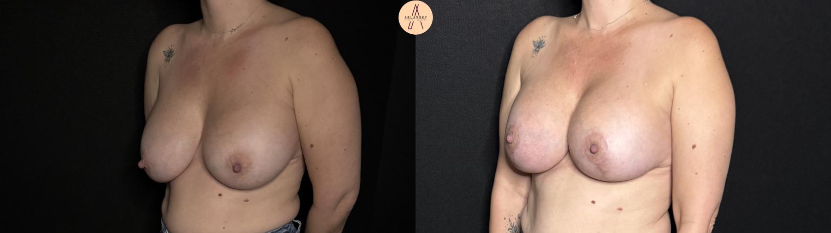 Before & After Implant Removal and Replacement  Case 353 Left Oblique View in San Antonio, Texas
