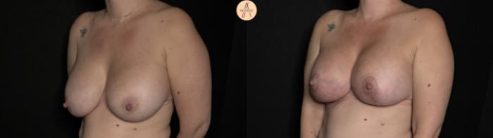 Before & After Implant Removal and Replacement  Case 353 Left Oblique View in San Antonio, Texas