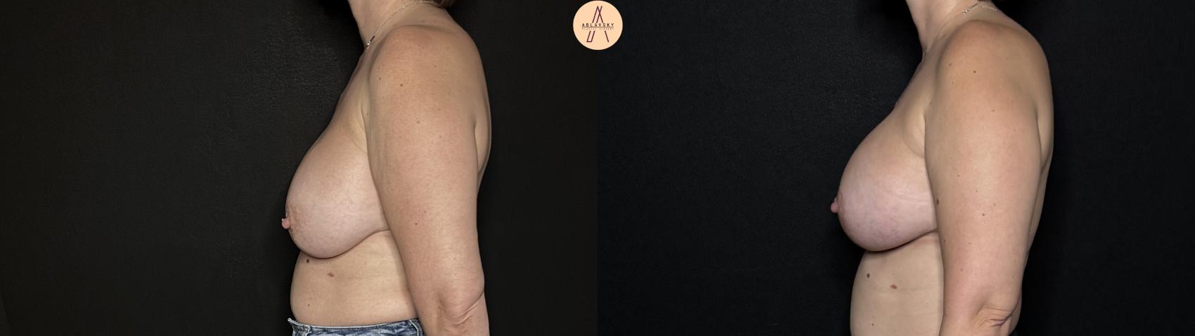 Before & After Implant Removal and Replacement  Case 353 Left Side View in San Antonio, Texas