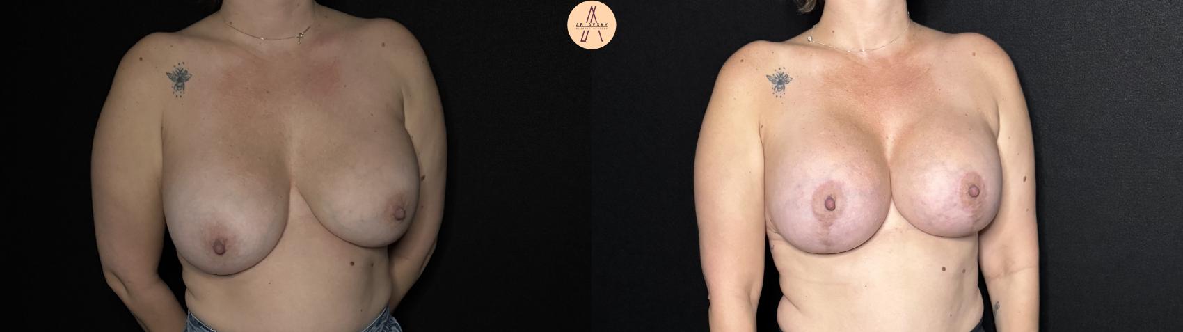 Before & After Implant Removal and Replacement  Case 353 Right Oblique View in San Antonio, Texas