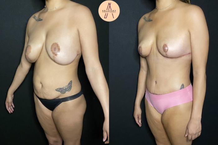 Before & After Implant removal, breast lift, abdominoplasty Case 211 Left Oblique View in San Antonio, Texas