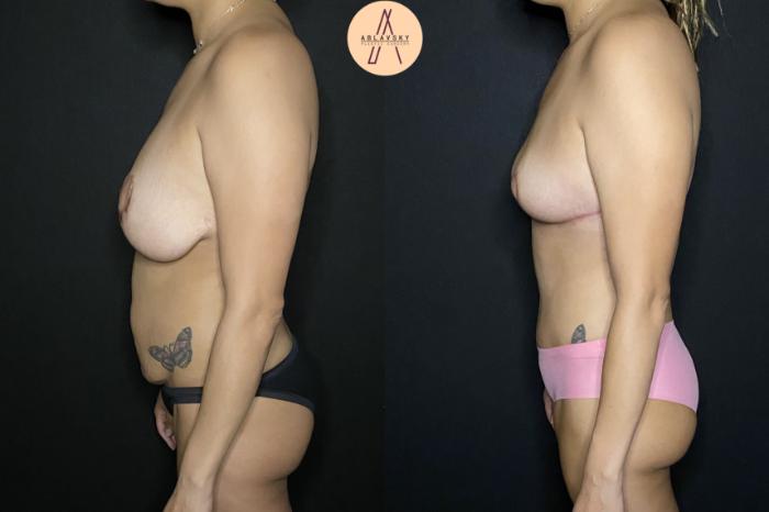 Before & After Implant removal, breast lift, abdominoplasty Case 211 Left Side View in San Antonio, Texas