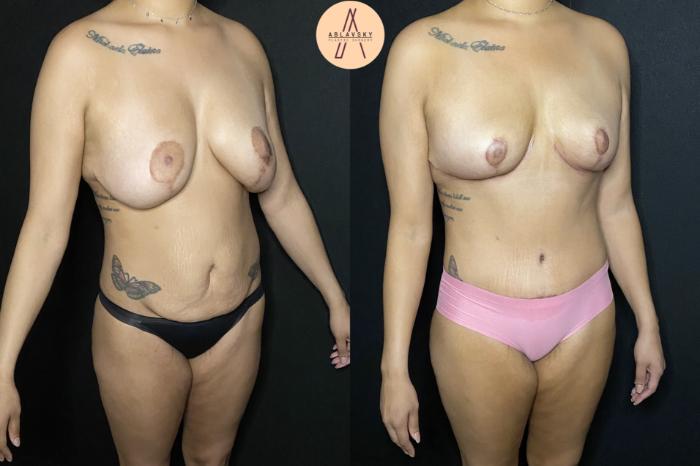 Before & After Implant removal, breast lift, abdominoplasty Case 211 Right Oblique View in San Antonio, Texas