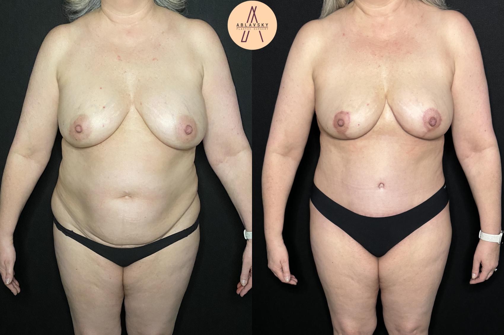 Before & After Implant removal, breast lift, abdominoplasty Case 238 Front View in San Antonio, Texas