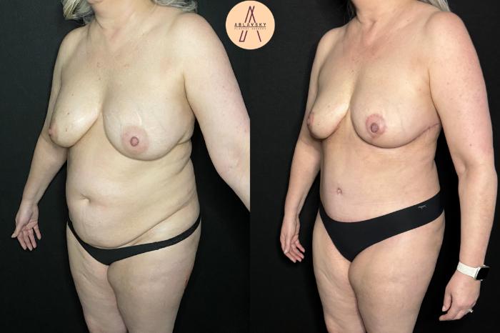 Before & After Breast Lift Case 238 Left Oblique View in San Antonio, Texas