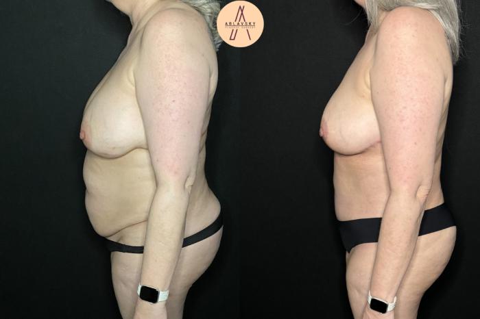 Before & After Implant removal w/ auto augmentation Case 238 Left Side View in San Antonio, Texas