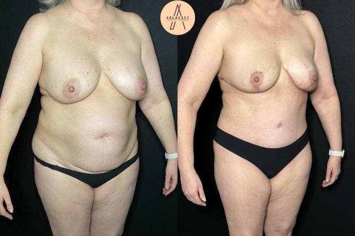 Before & After Liposuction Case 238 Right Oblique View in San Antonio, Texas