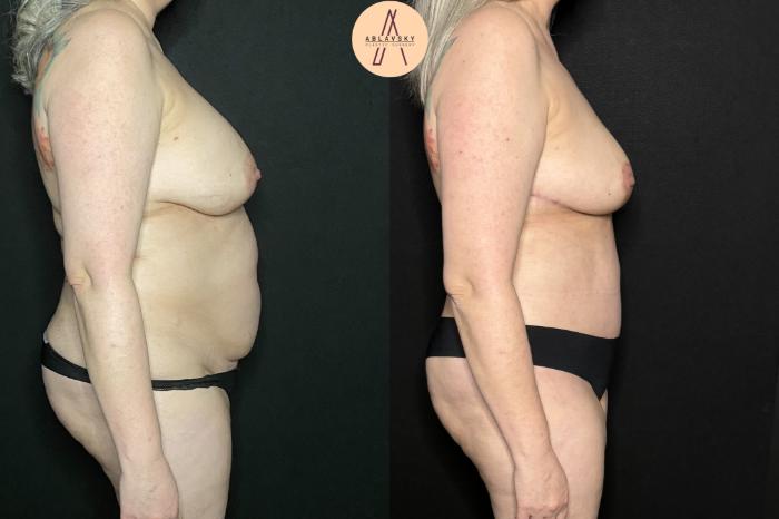 Before & After Breast Lift Case 238 Right Side View in San Antonio, Texas