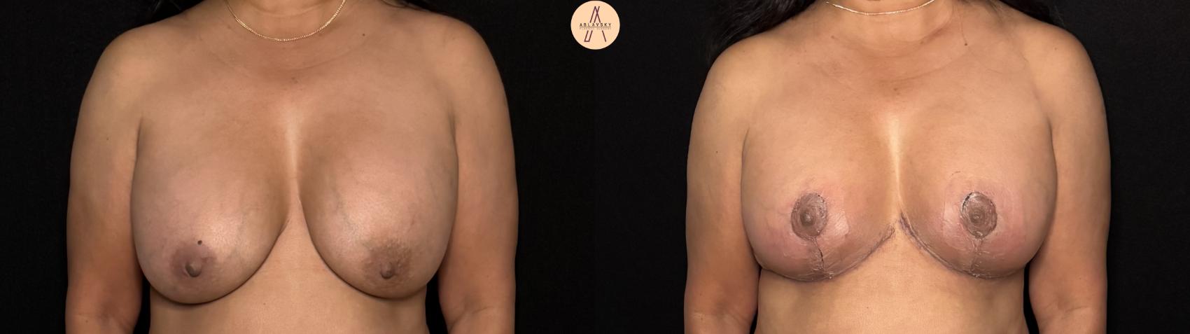 Before & After Breast Lift Case 417 Front View in San Antonio, Texas