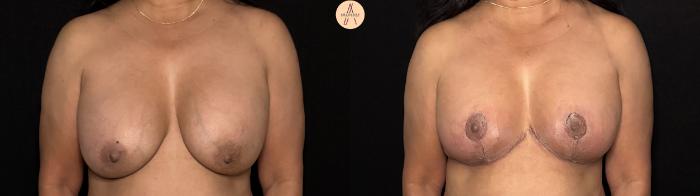 Before & After Implant removal replacement with breast lift Case 417 Front View in San Antonio, Texas