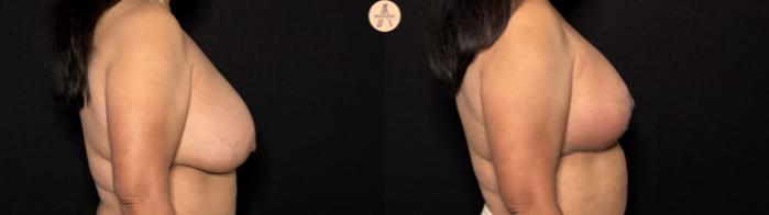 Before & After Breast Lift Case 417 Right Side View in San Antonio, Texas