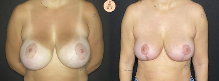 Before & After Implant removal w/ auto augmentation Case 172 Front View in San Antonio, Texas