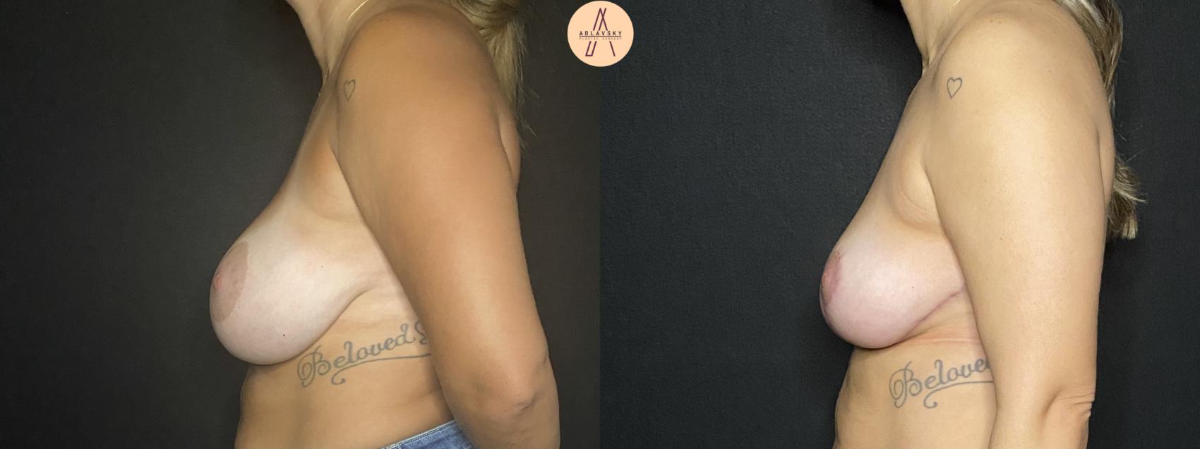Before & After Implant removal with breast lift and auto augmentation Case 172 Left Side View in San Antonio, Texas