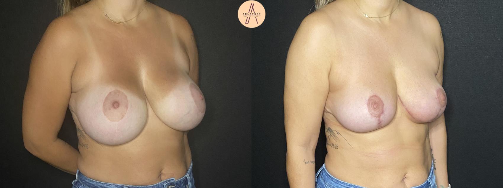 Before & After Implant removal w/ auto augmentation Case 172 Right Oblique View in San Antonio, Texas