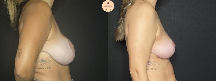 Before & After Implant removal w/ auto augmentation Case 172 Right Side View in San Antonio, Texas