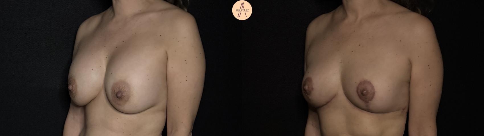 Before & After Implant removal w/ auto augmentation Case 356 Left Oblique View in San Antonio, Texas