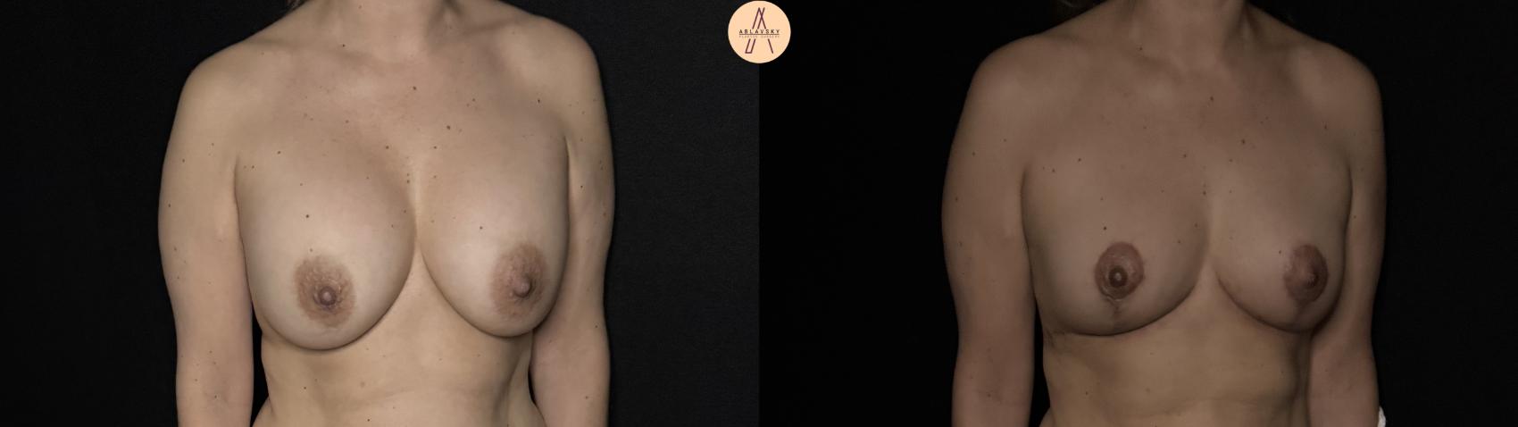 Before & After Implant removal w/ auto augmentation Case 356 Right Oblique View in San Antonio, Texas