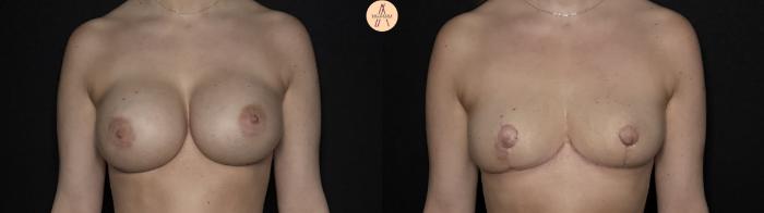 Before & After Implant removal w/ auto augmentation Case 365 Front View in San Antonio, Texas