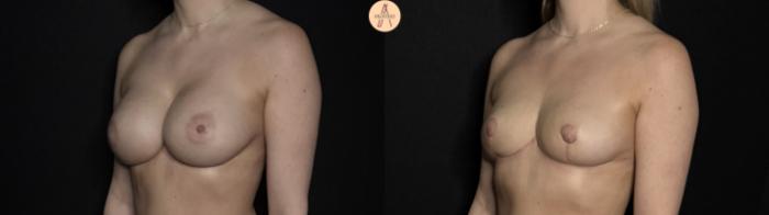 Before & After Implant removal w/ auto augmentation Case 365 Left Oblique View in San Antonio, Texas