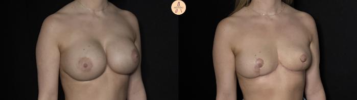 Before & After Implant removal w/ auto augmentation Case 365 Right Oblique View in San Antonio, Texas