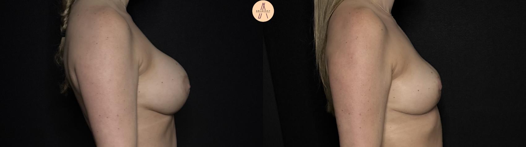 Before & After Breast Lift Case 365 Right Side View in San Antonio, Texas