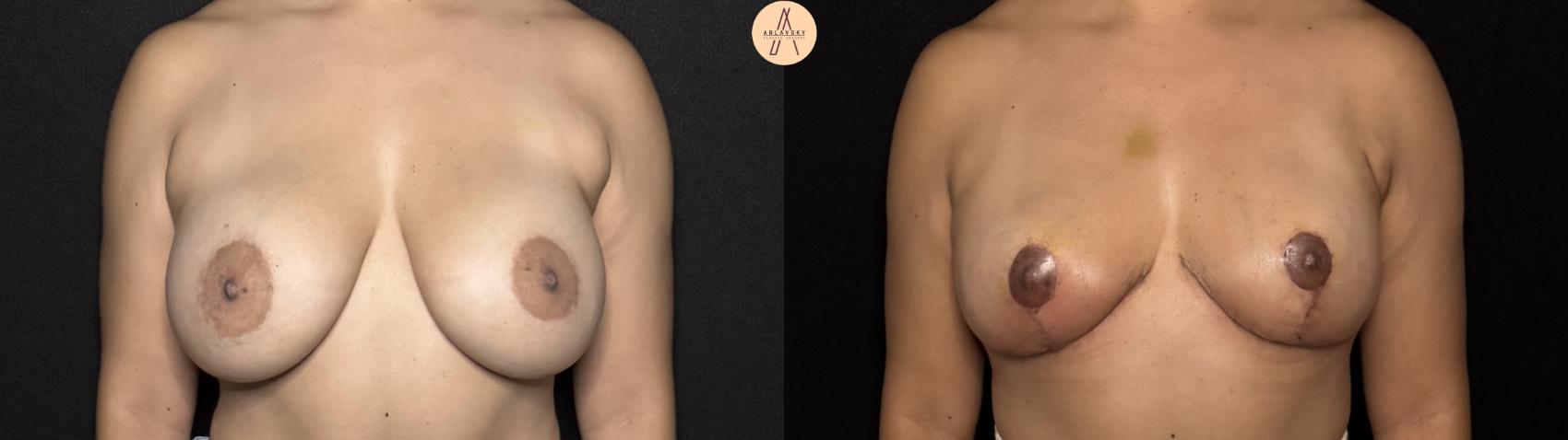Before & After Implant removal w/ auto augmentation Case 395 Front View in San Antonio, Texas