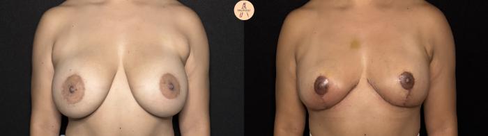 Before & After Implant removal w/ auto augmentation Case 395 Front View in San Antonio, Texas