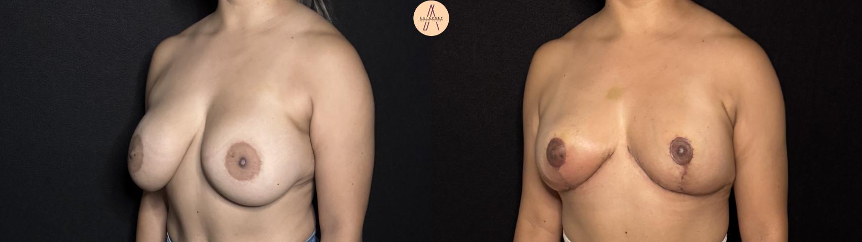 Before & After Implant removal w/ auto augmentation Case 395 Left Oblique View in San Antonio, Texas