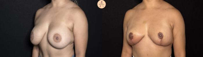 Before & After Implant removal w/ auto augmentation Case 395 Left Oblique View in San Antonio, Texas