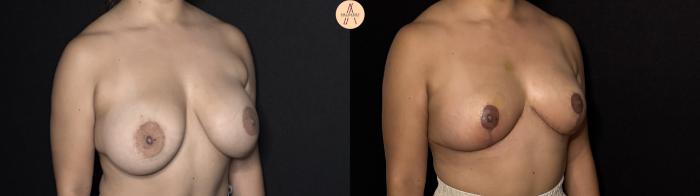 Before & After Implant removal w/ auto augmentation Case 395 Right Oblique View in San Antonio, Texas