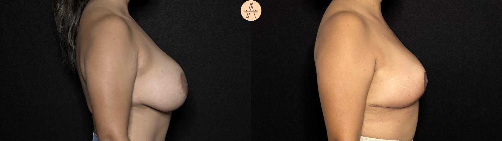 Before & After Implant removal w/ auto augmentation Case 395 Right Side View in San Antonio, Texas