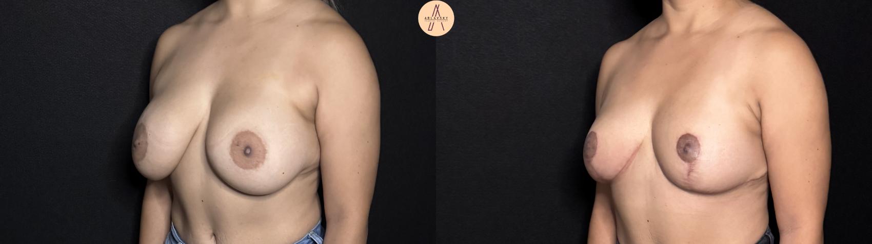 Before & After Implant removal with breast lift and auto augmentation Case 395 Left Oblique View in San Antonio, Texas