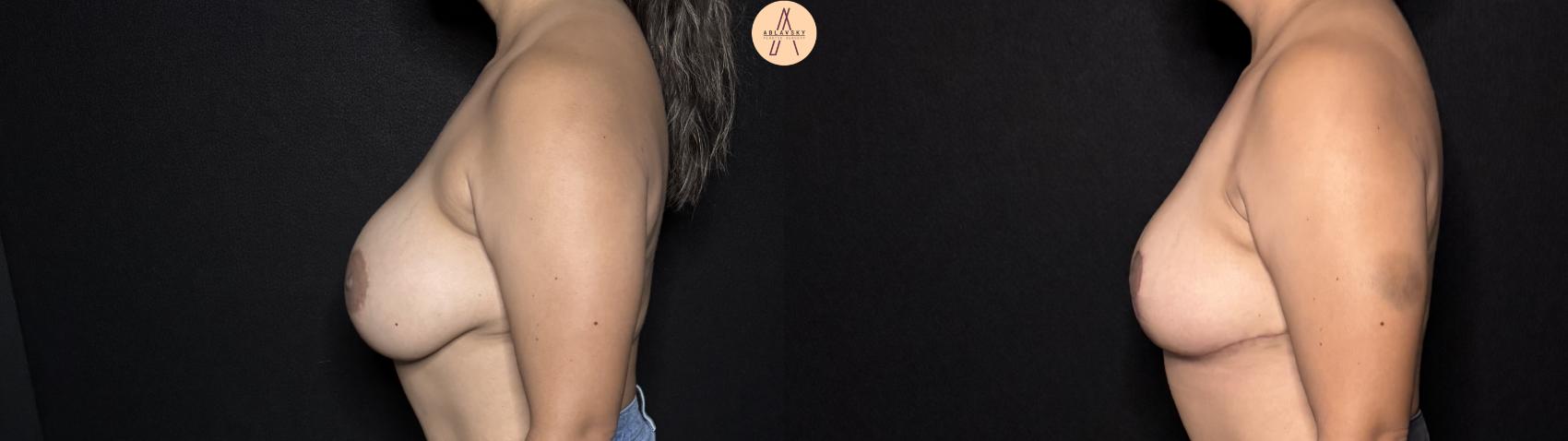 Before & After Implant removal with breast lift and auto augmentation Case 395 Left Side View in San Antonio, Texas