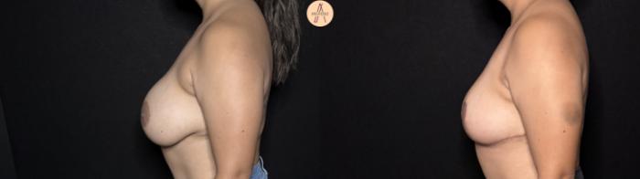 Before & After Implant removal with breast lift and auto augmentation Case 395 Left Side View in San Antonio, Texas