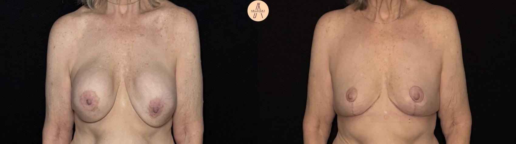 Before & After Implant removal with breast lift and auto augmentation Case 491 Front View in San Antonio, Texas