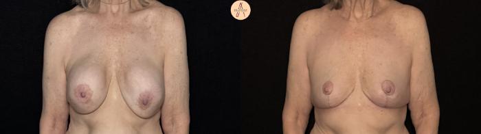 Before & After Implant removal with breast lift and auto augmentation Case 491 Front View in San Antonio, Texas