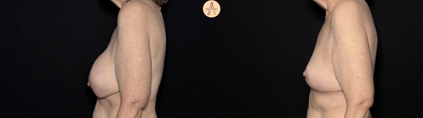 Before & After Implant removal with breast lift and auto augmentation Case 491 Left Side View in San Antonio, Texas