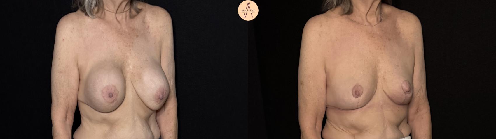 Before & After Implant removal with breast lift and auto augmentation Case 491 Right Oblique View in San Antonio, Texas