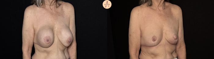 Before & After Implant removal with breast lift and auto augmentation Case 491 Right Oblique View in San Antonio, Texas