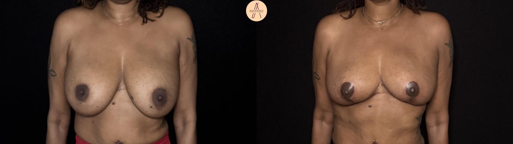 Before & After Implant removal with breast lift and auto augmentation Case 505 Front View in San Antonio, Texas