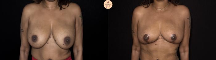 Before & After Implant removal with breast lift and auto augmentation Case 505 Front View in San Antonio, Texas