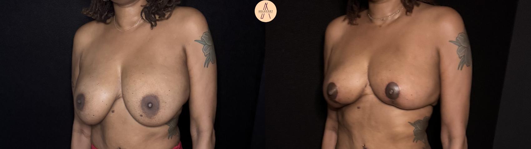 Before & After Implant removal with breast lift and auto augmentation Case 505 Left Oblique View in San Antonio, Texas
