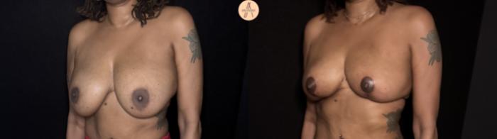 Before & After Implant removal with breast lift and auto augmentation Case 505 Left Oblique View in San Antonio, Texas